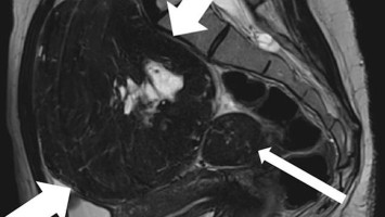 MRT des Beckens: Uterus und Ovarialtumoren