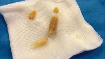 Geborgene Sekundenkleberfragmente aus Harnröhre