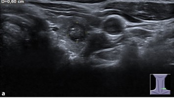Medulläres Schilddrüsenkarzinom linker Schilddrüsenlappen in der Sonographie