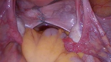 Uterosakralligamente 