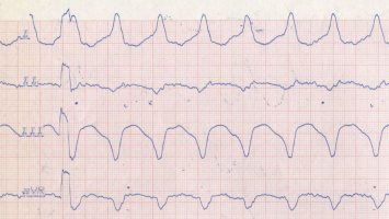 EKG bei ventrikulärer Tachykardie
