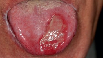 Ulzerative Form des oralen Lichen planus