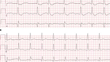 EKG bei normofrequentem Vorhofflimmern