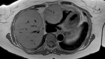 Rechtsatriale und rechtsventrikuläre Raumforderung