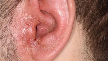 Otitis externa