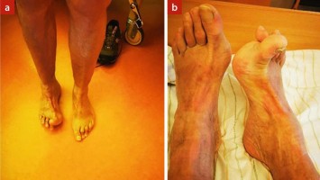 Fußdystonie Parkinson