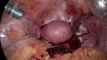 Extrauteringravidität 