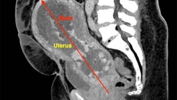 CT des Uterus einer 47-Jährigen 
