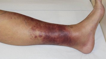 Hämorrhagisches Erysipel am Unterschenkel