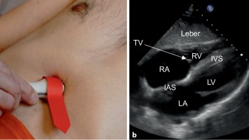 Fokussierter Herzultraschall (FoCUS)