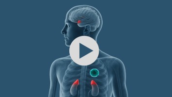 Teaserbild OA Cushing-Syndrom