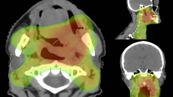 VMAT-Bestrahlungsplan einer definitiven Radiochemotherapie eines linksseitigen, lokal fortgeschrittenen Tonsillenkarzinoms