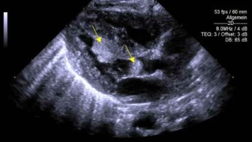 Rhabdomyom im Kindesalter 