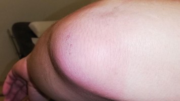 Schmerzhafte Schwellung des linken Ellenbogens