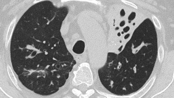 Bilaterale ausgedehnte zylindrische Bronchiektasen