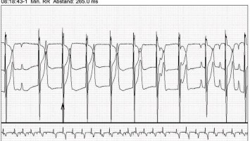 Langzeit-EKG mit junktionalem Ersatzrhythmus