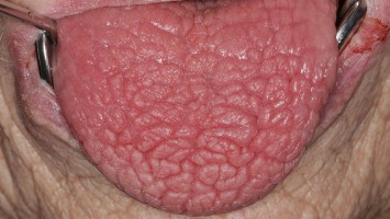 Mund mit herausgestreckter Zunge: Medikamenteninduzierte Xerostomie mit extrem trockener Mundschleimhaut