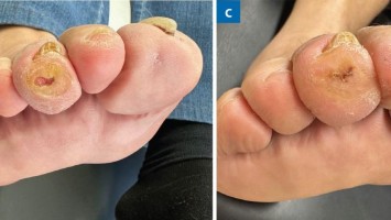 Behandlung eines diabetischen Druckulkus