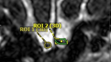 Volumetrie des Bulbus olfactorius
