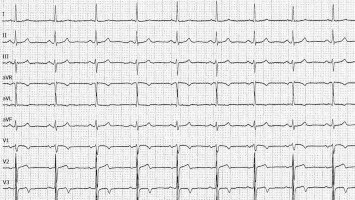 EKG bei RIVA-Stenose