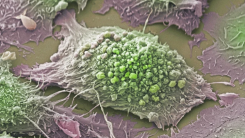 Rasterelektronenmikroskop-Aufnahme einer Lungenkrebszelle