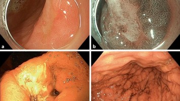 Endoskopische Befunde des Magenkarzinoms