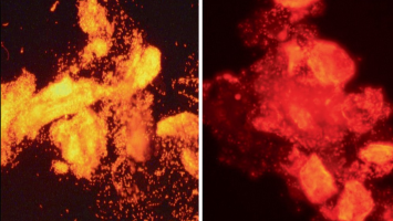Gardnerella spp. bedeckte Schlüsselzellen