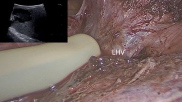 Kolorektale Lebermetastase in Segment II, nahe der linken Lebervene (LHV).
