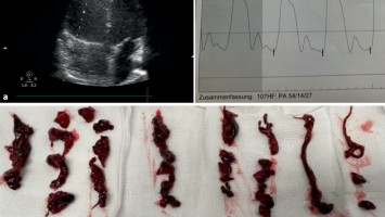 Kathetergestützte mechanische Thrombektomie 