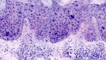 Ex vivo konfokales Laserscanmikroskopiebild eines Morbus Bowen