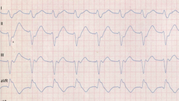 Extremitäten-EKG-Ableitungen