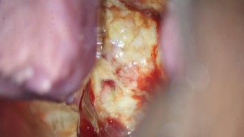 Glaszellentumor der Gebärmutter