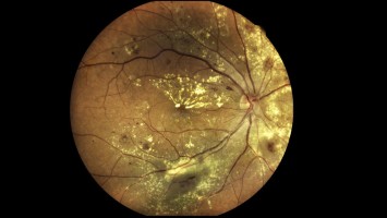 Altersbedingte Makuladegeneration