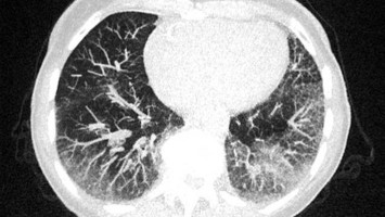 CT einer Lunge mit Milchglastrübungen