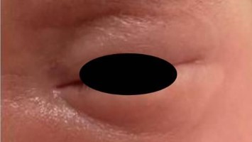 Racoon Eyes Neonataler Lupus erythematodes