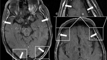 MRT-Aufnahmen der Kopfschwarte bei Riesenzellarteriitis