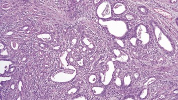 HPV-assoziiertes Adenokarzinom