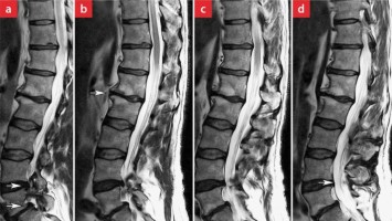 Sagittales T-2-gewichtetes MRT der LWS des Patienten