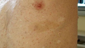 Neurofibromatose auf der Haut