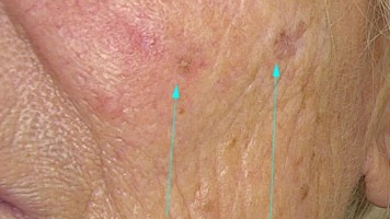 Hautveränderungen an der rechten Wange