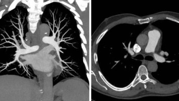 CT-Pulmonalisangiographie
