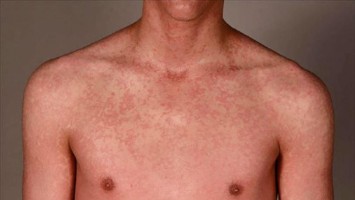 Kutane Arzneimittelreaktion