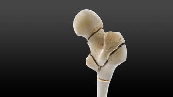 Fractuurpreventie, de NHG Standaard en dan...