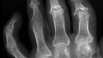 Röntgenbild einer Psoriasis-Arthritis