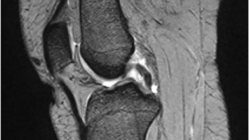 MRT-Sequenz des Knies