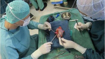 Operateure während Transplantation