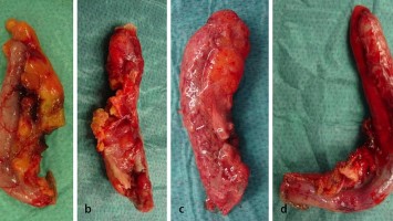 Verschiedene Stadien der Appendizitis