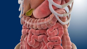 Gallensteine graphisch