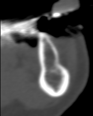 Abb. 01: Sagittales Schnittbild einer CT-Aufnahme im Bereich 34
