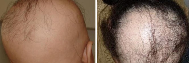 Alopezie Alopezie Springermedizin De